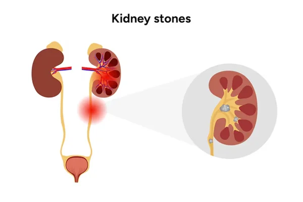 Uretric & Kidney Stone Removal